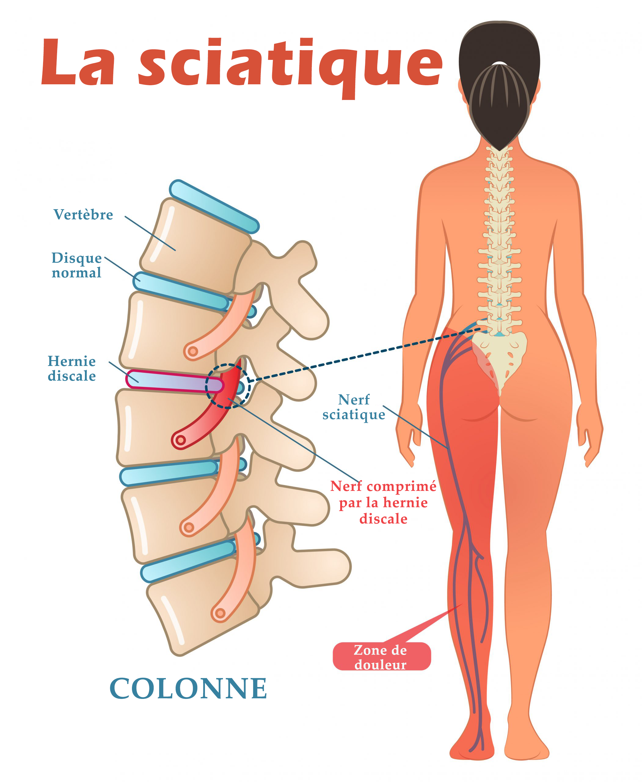 FR_B_SCIATICA-1